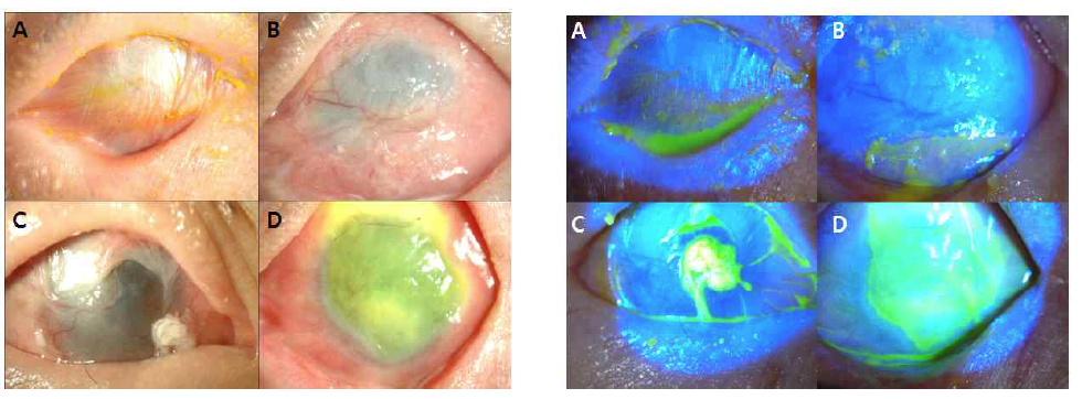 이식 전(A), 구석 재건 및 검구유착박리술 후(B), 이식 후 1주(C), 1개월(D) 시점의 세극등검사 결과