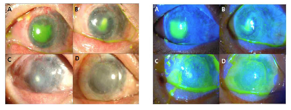 전층각막이식술 후 2주(A), 1개월(B), 5개월(C), 8개월(D) 시점의 세극등검사 결과