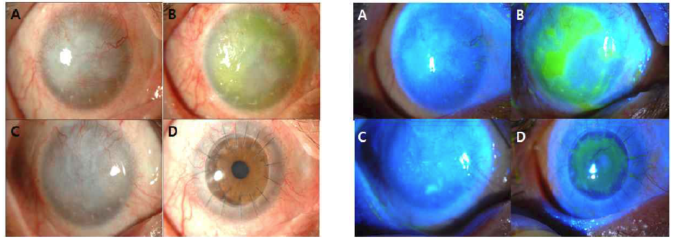 이식 전(A) 및 이식 후 1개월(B), 6개월(C), 전층각막이식술 후 4개월 시점의 세극등검사 결과
