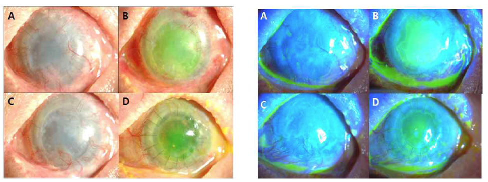 이식 전(A), 이식 후 1개월(B), 6개월(C) 및 전층각막이식술 후(D)의 세극등검사 결과