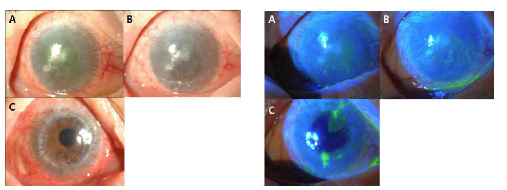 이식 후 3개월(A), 6개월(B) 시점 및 전층각막이식술 후(C)의 세극등검사 결과