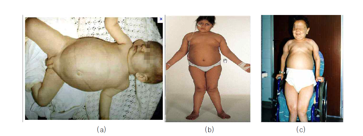 Glycogen storage disease typeⅠ(a and b) and typeⅦ (c)