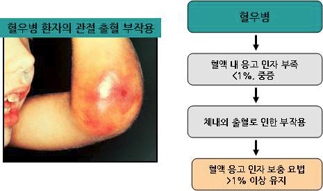 혈우병 환자의 증상과 치료법