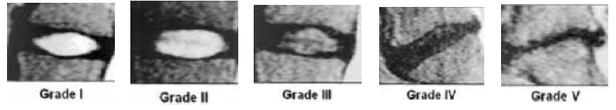 MRI 이용한 퇴행성 추간판 등급