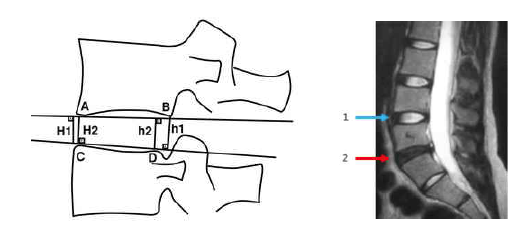 (좌) 추간판 높이 (Disc Height Index, DHI) 변화 측정, Farfan method: DHI =(H1+H2+H3+H4)/4, (우) 추가판의 T2 MRI 소견: 퇴행성 변화가 있는 추가판 (2)은 정상 추간판 (1)에 비해 신호강도가 낮음.