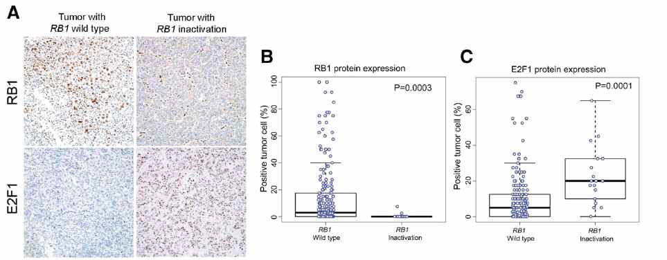 RB1의 돌연변이로 인한 RB1와 E2F1의 발현 수준