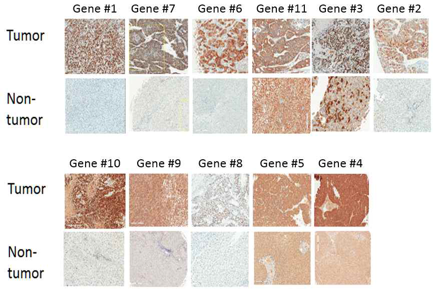 11개 마커의 간세포암 조직 및 비종양성 조직에서 발현 형태