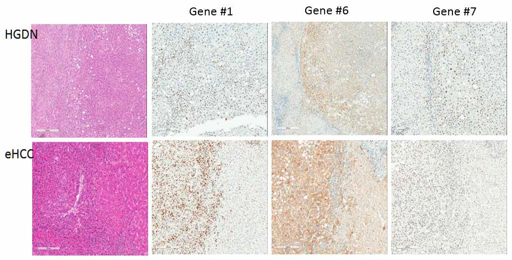 조기 간세포암 및 고분화 이형성 결절에서 3 마커의 발현