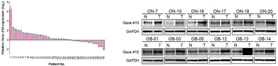 Gene #10의 간암환자 조직에서 mRNA, 단백질 발현 분석