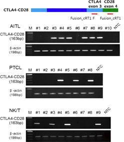 아형 별 환자 검체에서 RT PCR을 통한 CTLA4-CD28 변이의 유무 확인