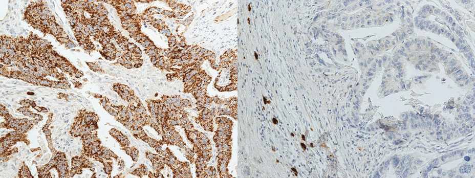 PAI에 대한 immunohistochemical staining결과. 좌측) T3N3 group에서 positive staining. 우측) T4N0 group에서 negative staining.