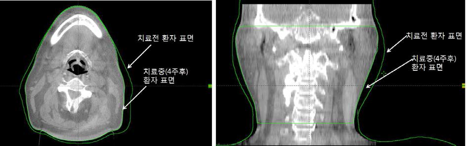 방사선치료를 받는 두경부암 환자의 치료전 및 치료중 (4주후) 몸무게의 변화 및 부피변화에 따라서 CT image 상에서 나타나게 됨.