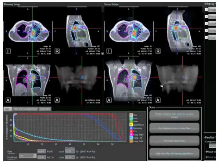 ViewRayTM 치료계획 시스템을 이용한 다른 MRI영상에서의 선량분포 차이를 계산함.