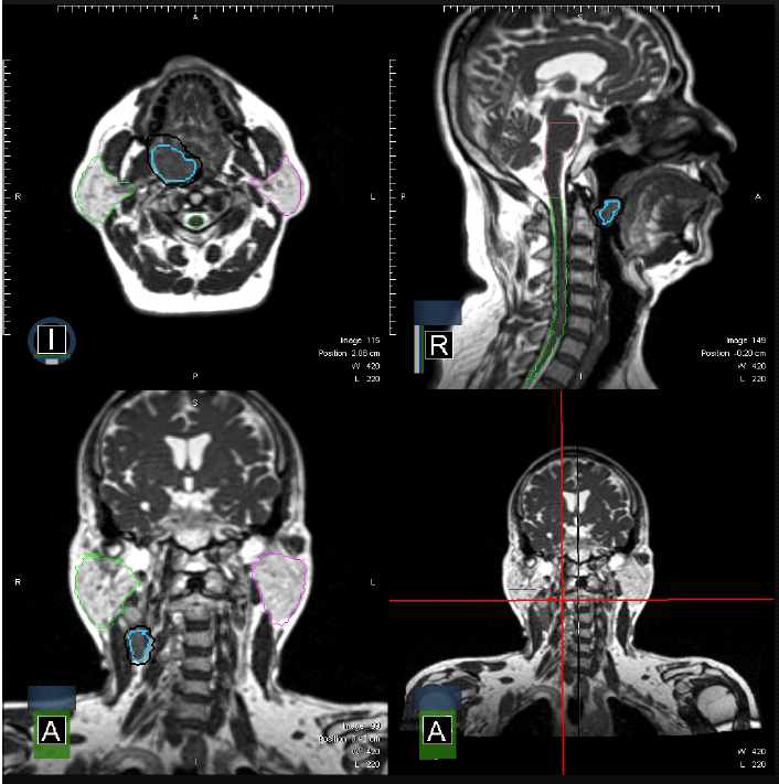 PTV 및, Parotid, Spinal cord, Brainstem을 치료 과정 중 획득한 MRI 영상에 Contouring 함.
