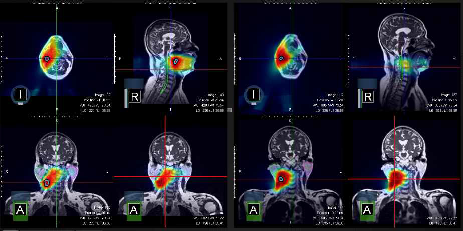 초기 치료계획과(좌) 치료 경과 한달 후(좌) MRI 영상과 PTV 변화에 따른 방사선량 분포 차이