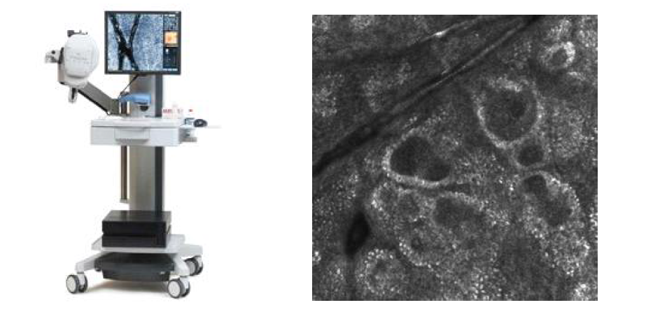 in vivo Reflectance Confocal Microscope(Left) and papillae surrounded by a rim of small bright cells sharply contrasting with the dark background(Right)