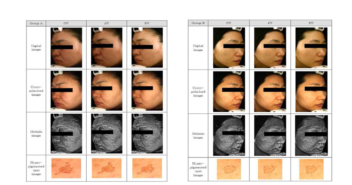 과색소침착 부위의 이미지 (Left: Test group (A); Right: Control group (B))