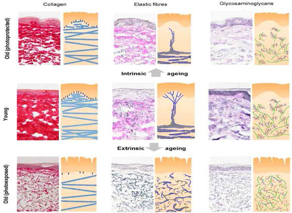 내인성 및 외인성 피부의 세포외 기질 (ECM) 리모델링. 진피의 콜라겐, 탄력섬유, 글리코사미노글리칸 (붉은색으로 표시됨)의 리모델링이 내인성 및 외인성 노화가 진행된 피부에서 관찰됨. 노화가 진행된 양성이 조직학적으로 서로 다른 것을 주목.