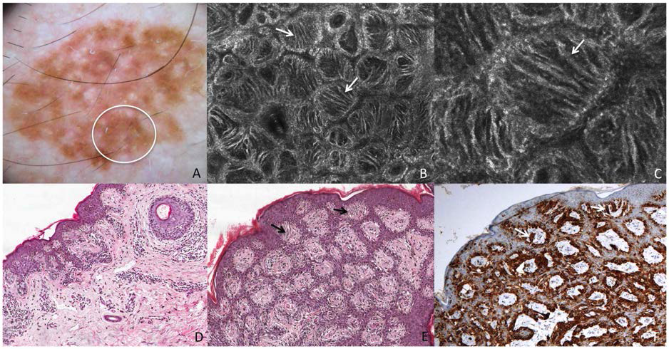 표피의 흑색종의 진단 A: 피부경(dermoscopy) B&C: RCM (Reflectance Confocal Microscopy) D&E: H&E 조직염색 F: Melan-A staining