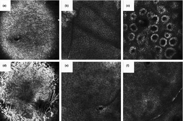 Reflectance confocal microscopy(RCM) 이미지.