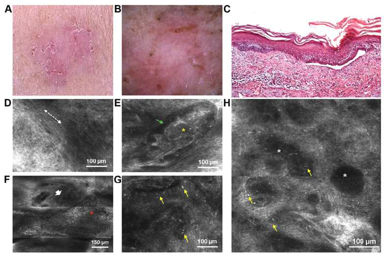 (A)피부암 일반사진, (B) Dermoscopy 이미지, (C) 병변의 조직학적 단면도, (D-H) 표피층의 RCM 이미지