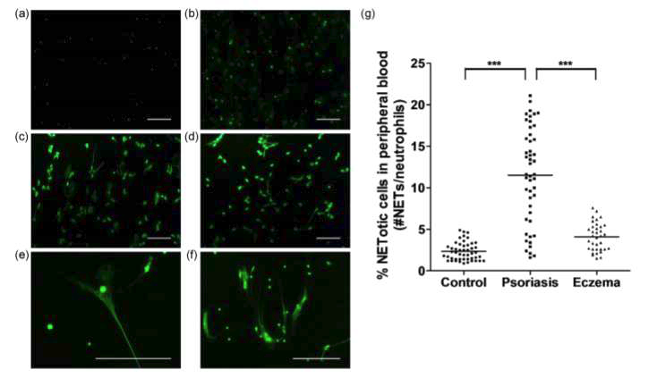 형광현미경을 이용한 말초 혈액 내의 NETotic cell 관찰