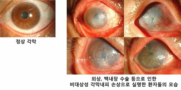 (좌) 정상 각막 (우) 난치성 각막 내피 손상 환자