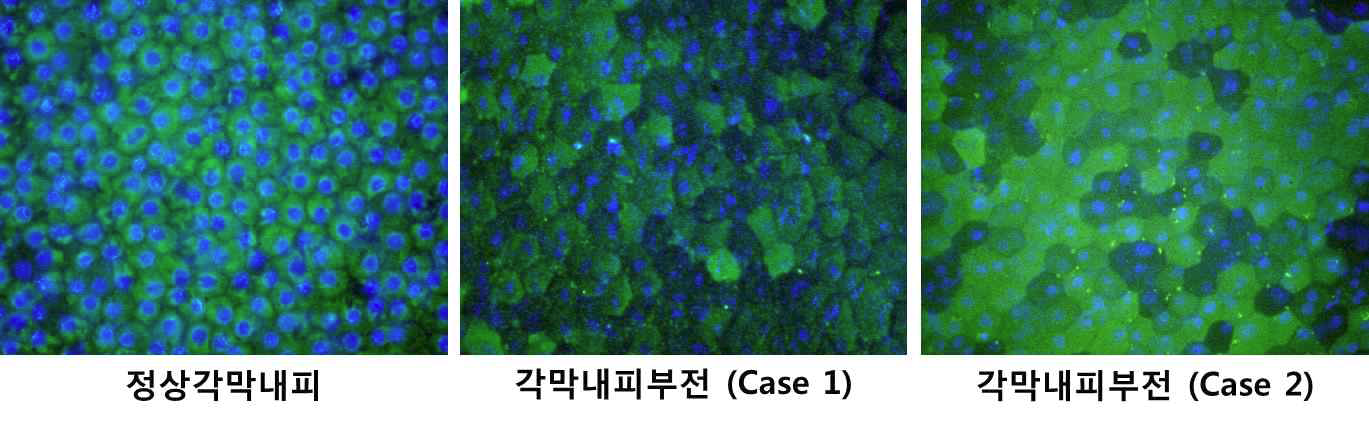 정상각막내피 (좌, green, ×200) 에 비해 각막내피부전 환자에서 각막내피세포들의 세포질 내 angiogenin의 부분적 저발현이 뚜렷함 (중간 및 우, green, ×200).