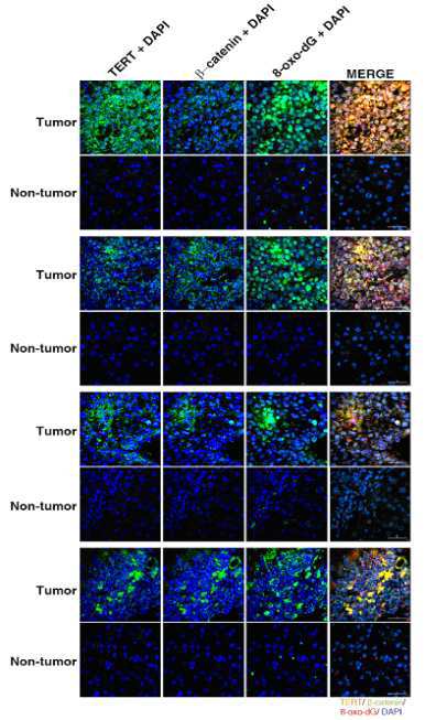 HCC cell에서 ROS level과 β-catenin, TERT expression 측정을 하기 위하여 immunostaining을 수행함.