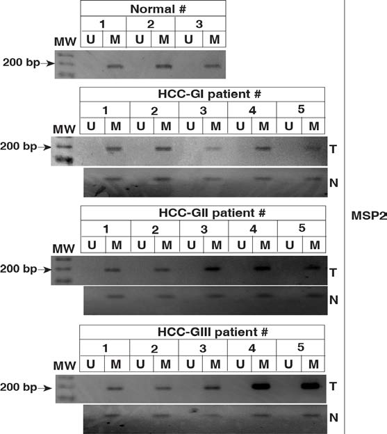 간암환자 조직에서의 MSP2 region을 타겟한 MS-PCR 결과 그림