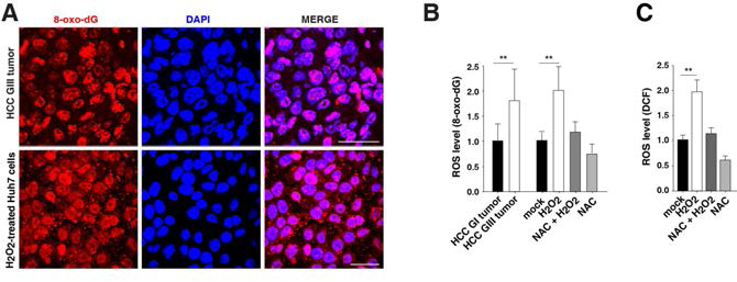 Malignant HCC (HCC grade III)와 ROS를 처리한 간암세포주에서의 ROS level 측정. A. 8-oxo-dG staining 그림 B. 8-oxo-dG staining을 수치화한 그래프 C. DCF로 ROS level 측정
