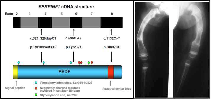 SerpinF1 유전자 구조 및 돌연변이에 의한 골형성 이상 유발.