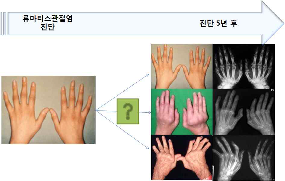 류마티스관절염 진단 후 시간경과에 따른 개인별 관절변형의 다양성