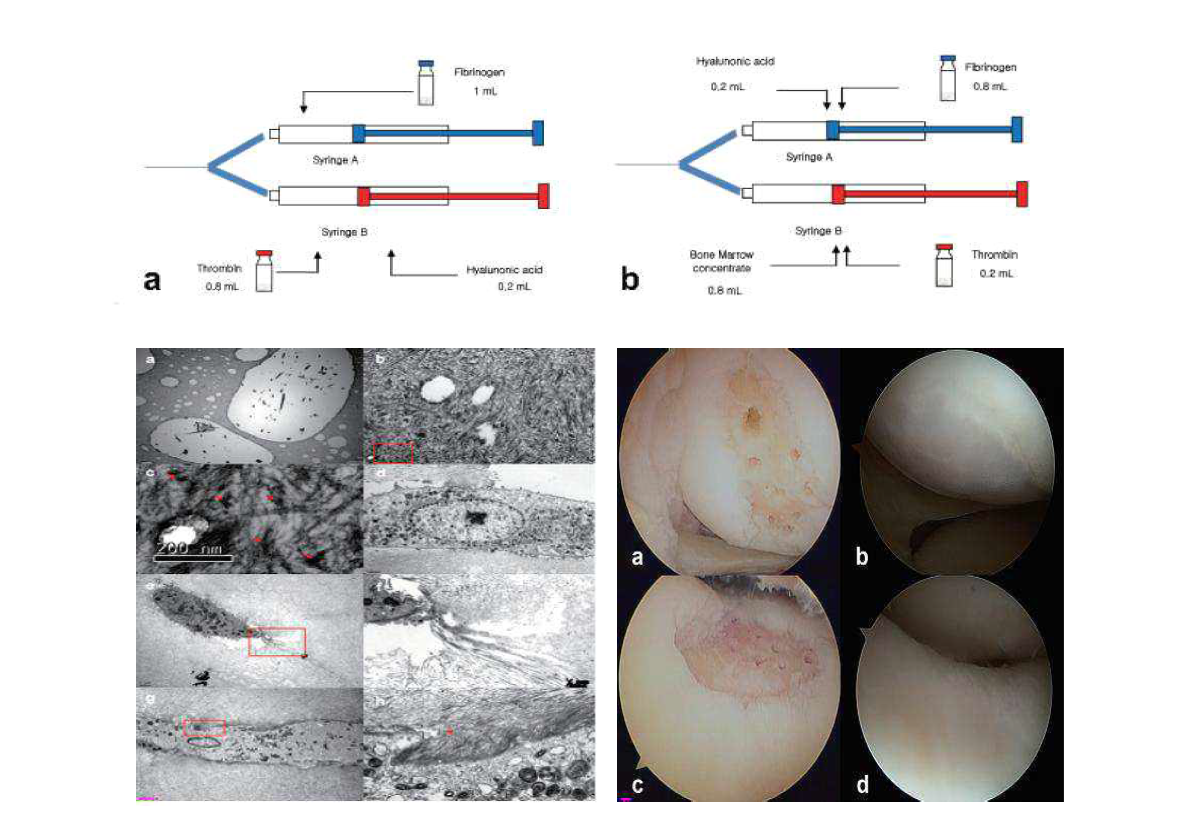 결합조직 재생용 조성물 및 결합조직을 재생하는 방법을 이용한 연골손상 회복 (관절경 사진 C)