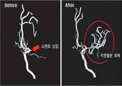 스텐트의 시술 효과