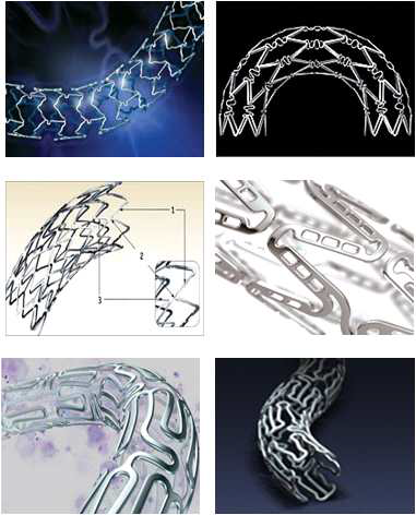 주요 관상동맥용 스텐트 (coronary stent)