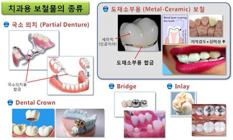 도재소부용 보철을 포함한 치과용 보철합금의 사용 예.