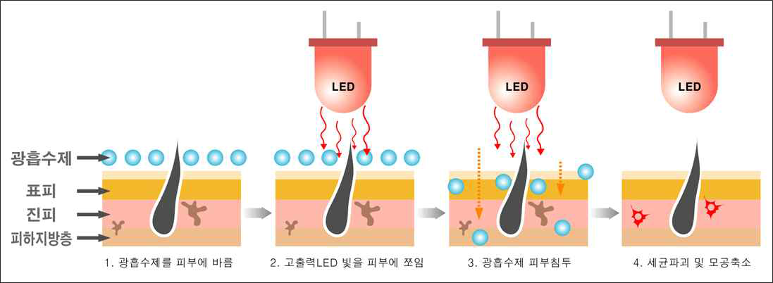 광역학적 치료법의 원리