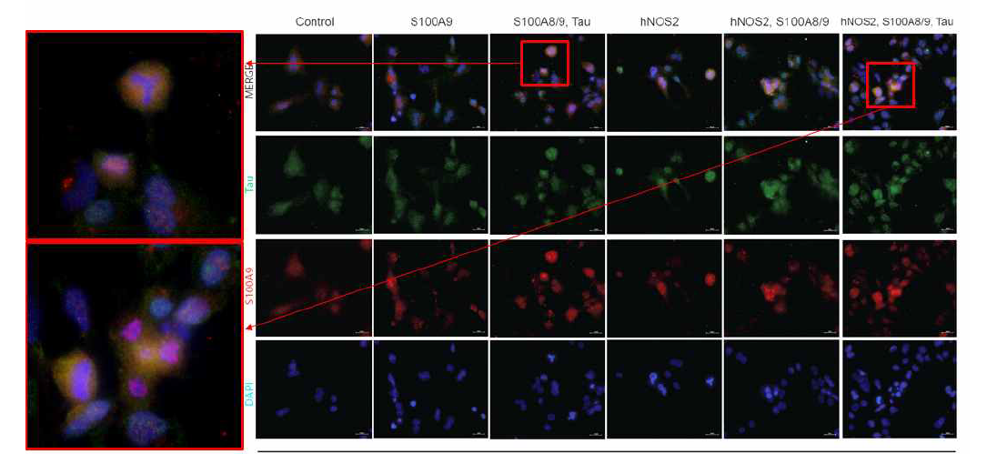 hNOS2, S100A8/9, GFP-Tau을 함께 Transfection시킨 HEK293 세포의 S100A9, Tau염색