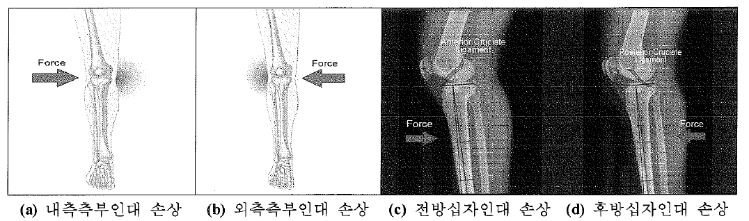 무릎 인대별 부상 메커니즘