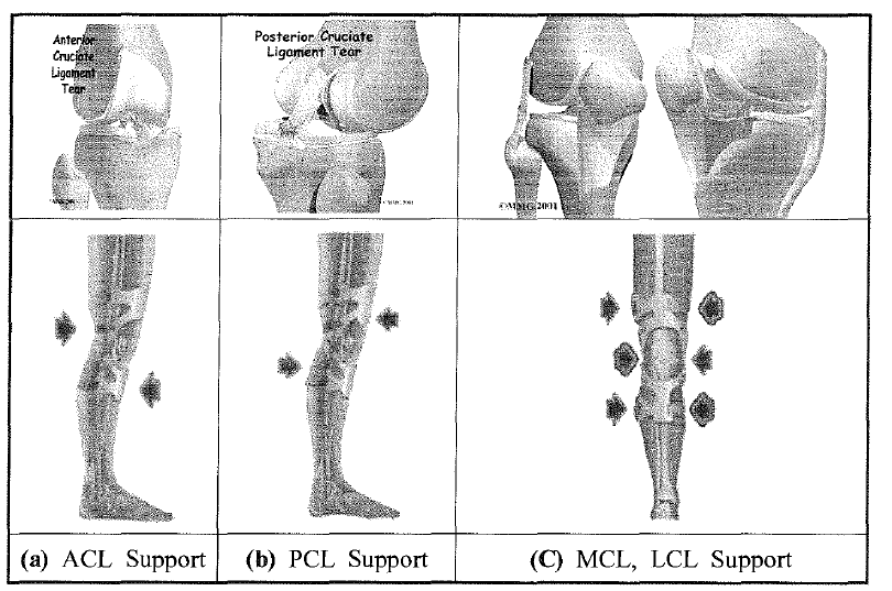 인대손상 유형 따른 무릎 보조기의 기능