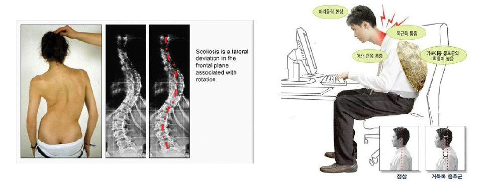 허리측만증 및 거북목 증후군