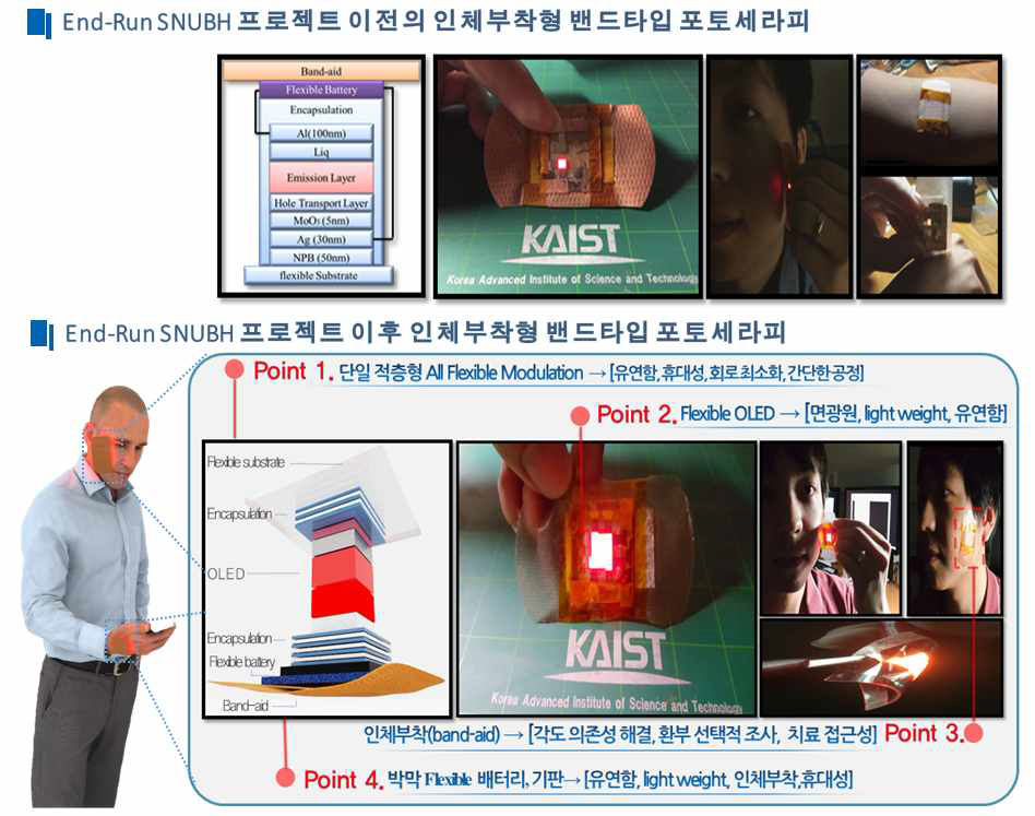 End Run SNUBH 협업 과제를 통한 밴드타입 포토세라피 플랫폼의 연구 성과