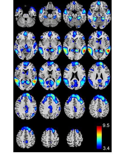 모든 피험자들에서 WCST task 수행 시 WCST>Fixation 과 Neutral>Fixation 분석에서 유의한 결과를 보인 뇌부위