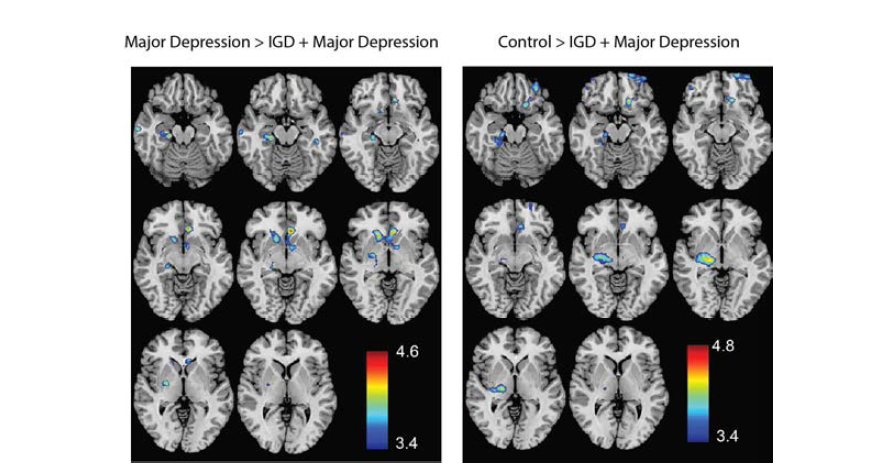 좌: 우울증 (major depression)>IGD + 우울증 분석에서 유의한 결과를 보인 뇌부위. 우: Control>IGD+MDD 분석에서 유의한 결과를 보인 뇌부위