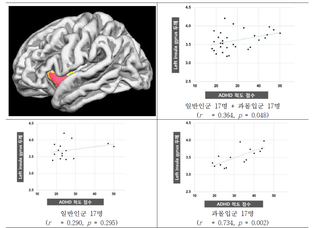 ADHD 증상의 정도와 대뇌피질두께와의 상관