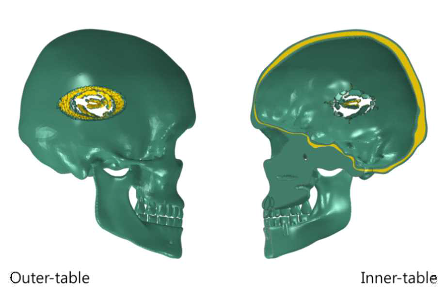 직경 50mm 의 원형봉을 이용한 충격 시험에서 두개골 내외측에 나타난 골절