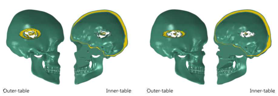 충격 시험시 outer-table 과 Inner-table 의 변형 및 파손