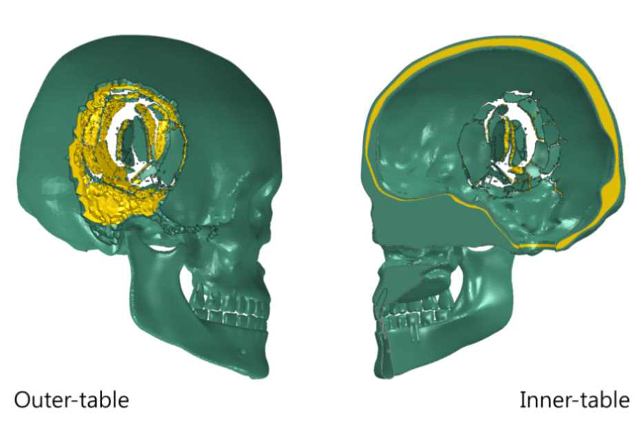 5m 높이에서 추락한 경우 두개골 내외측에 나타난 골절