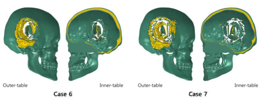 충격 시험시 outer-table 과 Inner-table 의 변형 및 파손